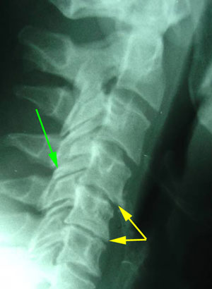 disc degeneration treated at Wilson Family Chiropractic