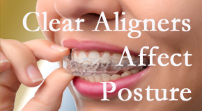 Clear aligners influence posture which Millville chiropractic helps.