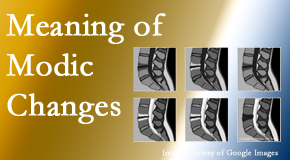 Wilson Family Chiropractic sees many back pain and neck pain patients who bring their MRIs with them to the office. Modic changes are often noted. 