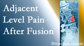 Wilson Family Chiropractic offers relieving care non-surgically to back pain patients suffering with adjacent level pain after spinal fusion surgery.