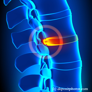 picture of lumbar Millville disc herniation