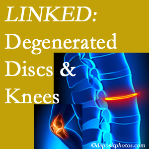 Degenerated discs and degenerated knees are not such strange bedfellows. They are seen to be related. Millville patients with a loss of disc height due to disc degeneration often also have knee pain related to degeneration.  