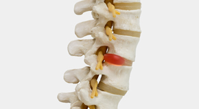 Millville chiropractic conservative care helps even huge disc herniations go away