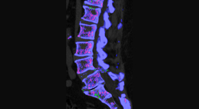 Wilson Family Chiropractic is aware that inflammatory spinal gout is a differential diagnosis to consider for patients who present with back pain and other spine related symptoms.