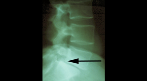 Millville spondylolisthesis 