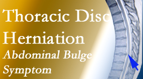 Wilson Family Chiropractic treats thoracic disc herniation that for some patients prompts abdominal pain.