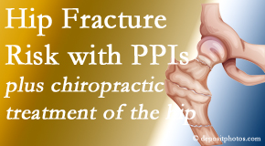 Wilson Family Chiropractic shares new research describing increased risk of hip fracture with proton pump inhibitor use. 