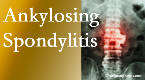 Ankylosing spondylitis is gently cared for by your Millville chiropractor.
