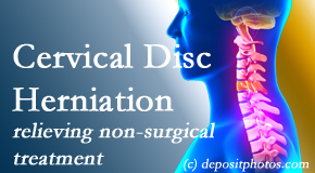 Wilson Family Chiropractic offers the Cox® Technic spinal manipulation to treat cervical radiculopathy and avert surgery. 