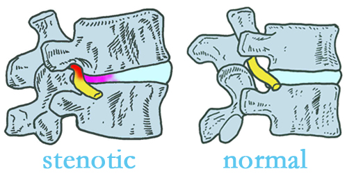 Millville stenotic and normal spinal discs