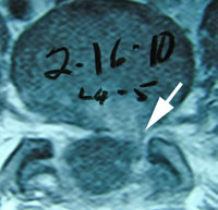 leaking nuclear material of the disc