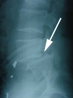 spondylolisthesis xray