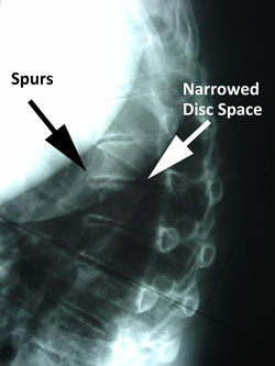 thoracic degenerative disc disease